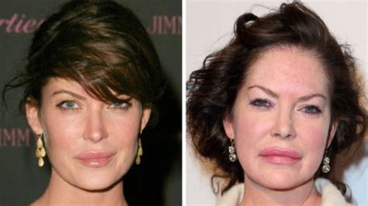 Les pires ratés de la chirurgie esthétique des stars